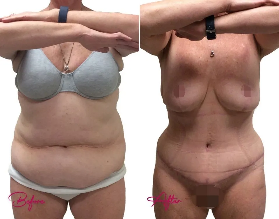 Before and after tummy tuck case 16 showing torso and abdominal reshaping