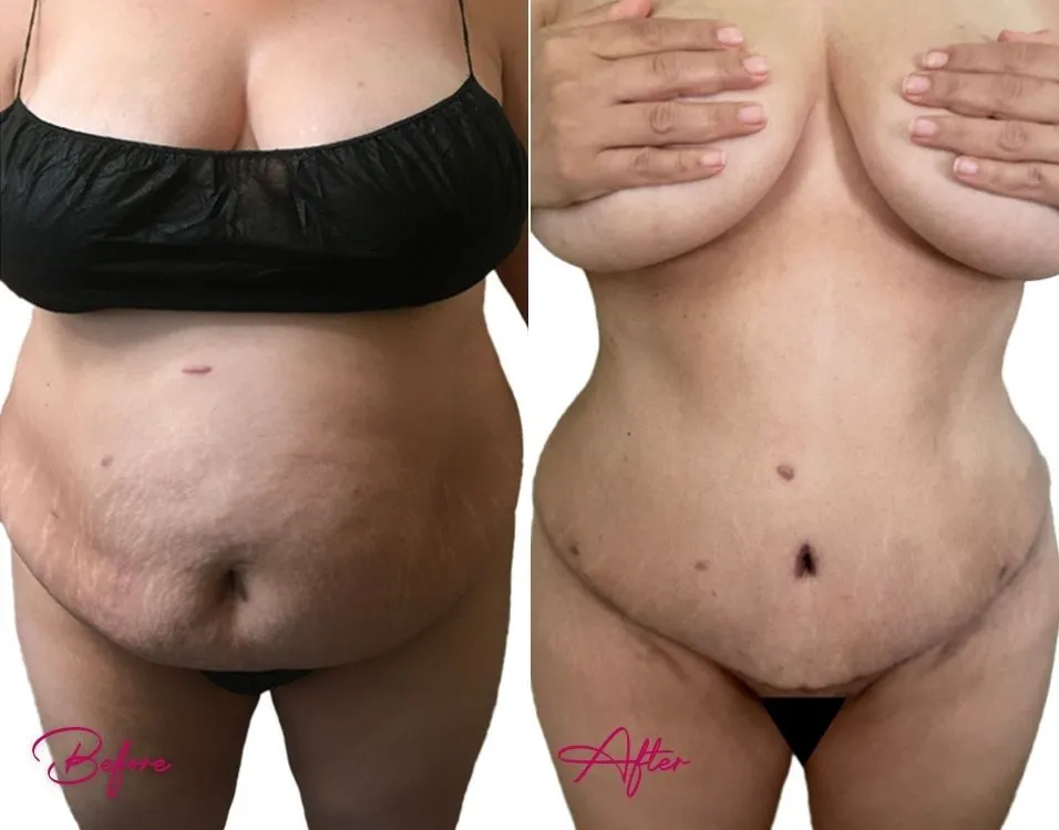 Before and after tummy tuck case 17 showing abdominal contouring results