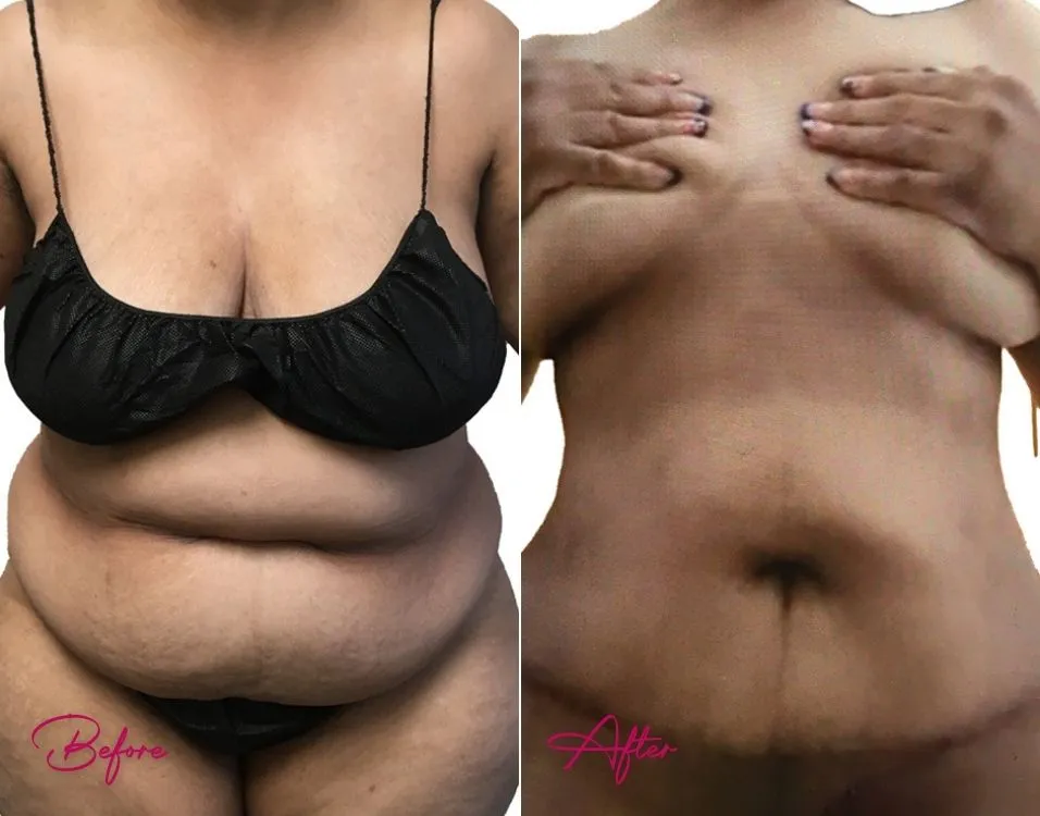 Before and after tummy tuck case 18: frontal view showing reduced abdominal skin and contour improvement