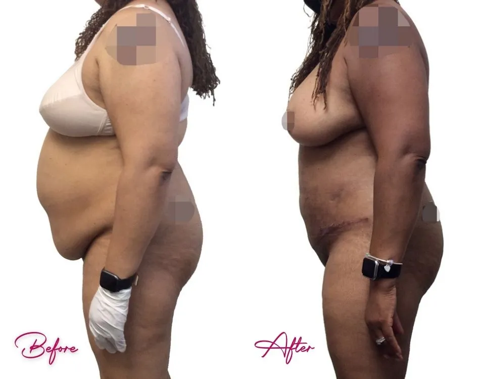 Before and after tummy tuck case 19: side profile showing flattened abdomen and improved body contour