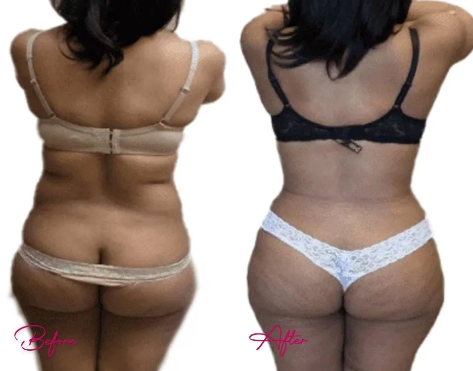 Tummy Tuck - Case 5