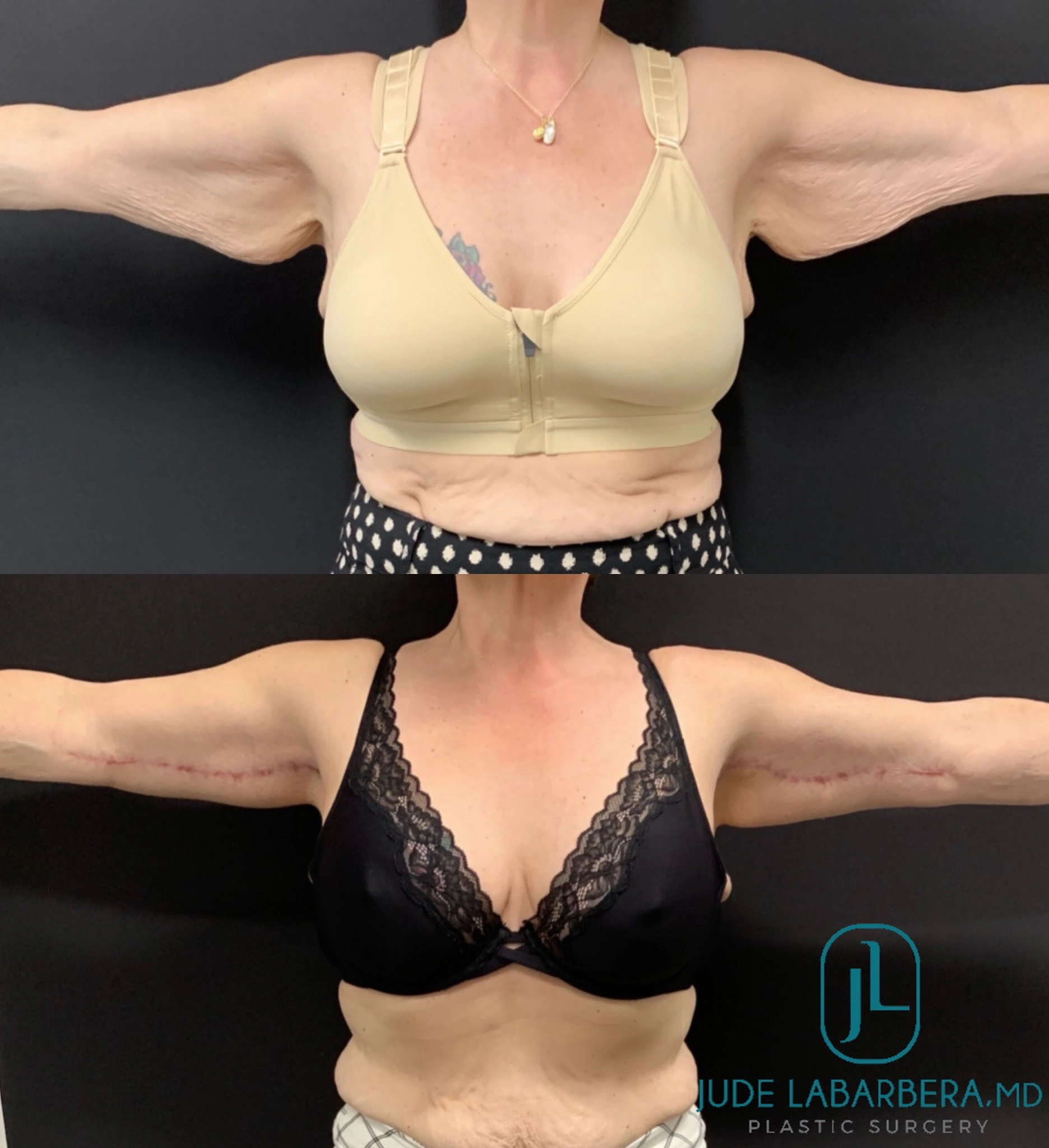 ARM LIFT Before & After Case Number 0002