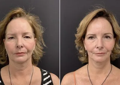 FACELIFT Before & After