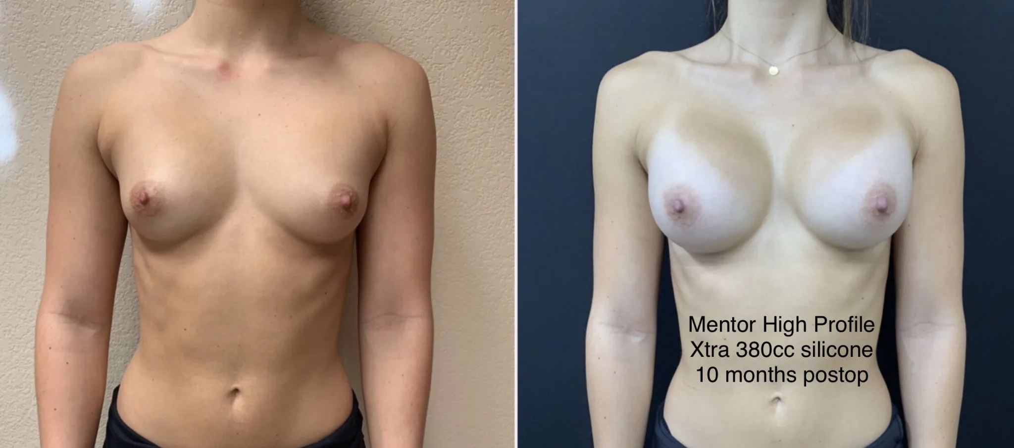 BREAST AUGMENTATION Before & After
