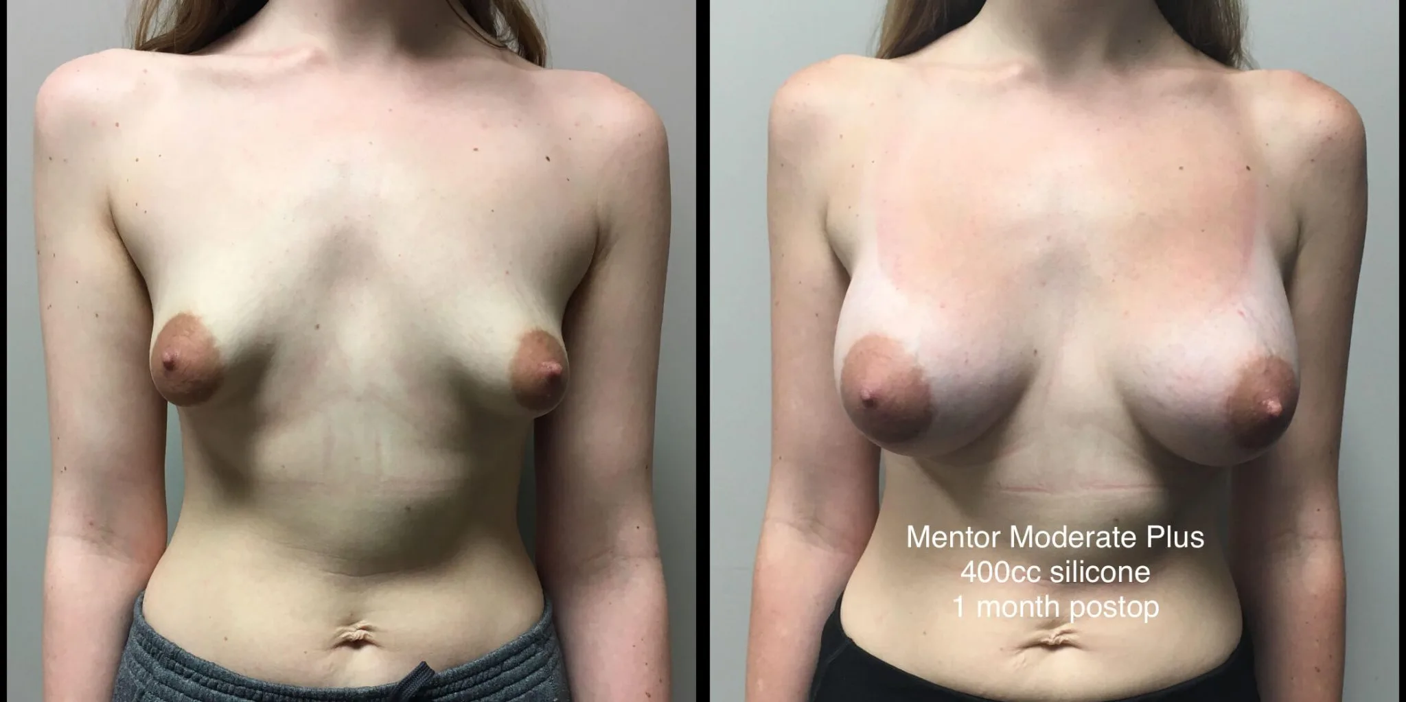 BREAST AUGMENTATION Before & After