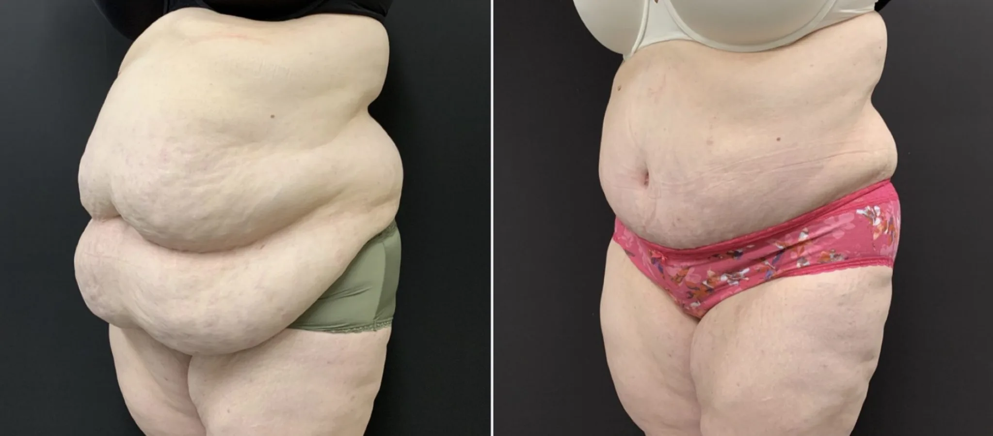 Abdominoplasty Before & After Case Number 00048