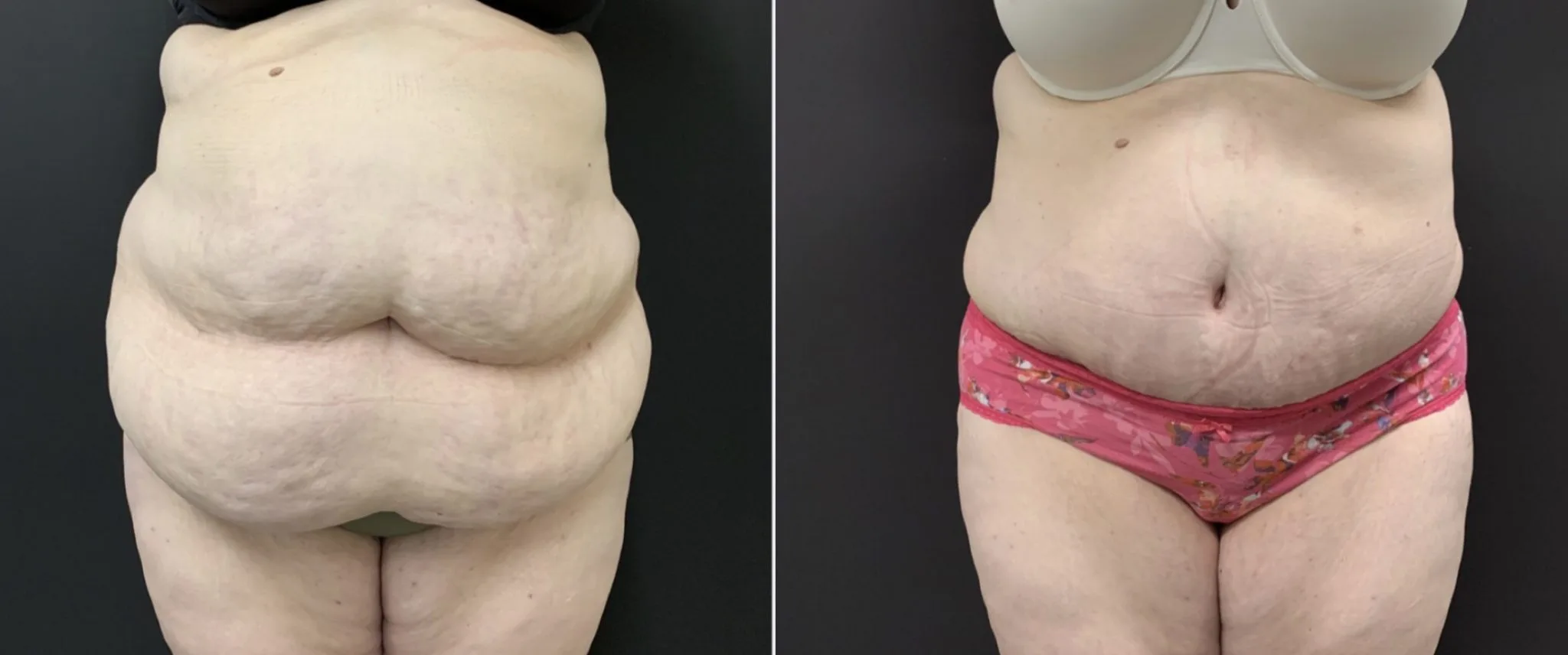 Abdominoplasty Before & After Case Number 00048