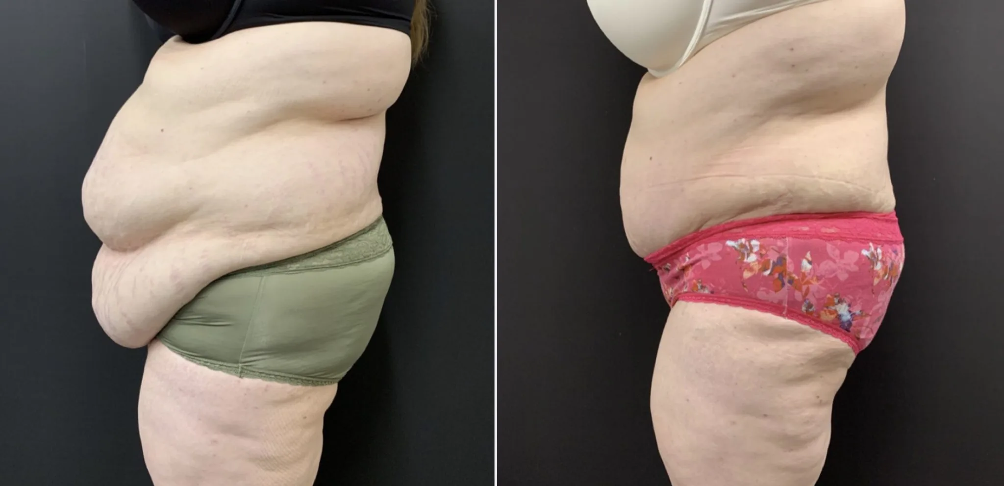 Abdominoplasty Before & After Case Number 00048