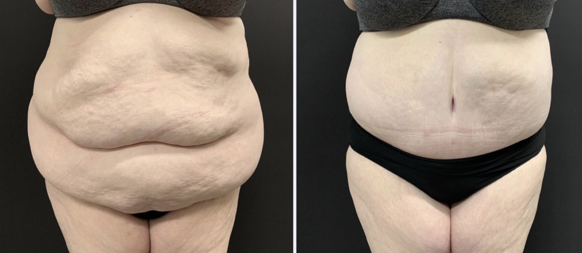 Abdominoplasty Before & After Case Number 00049