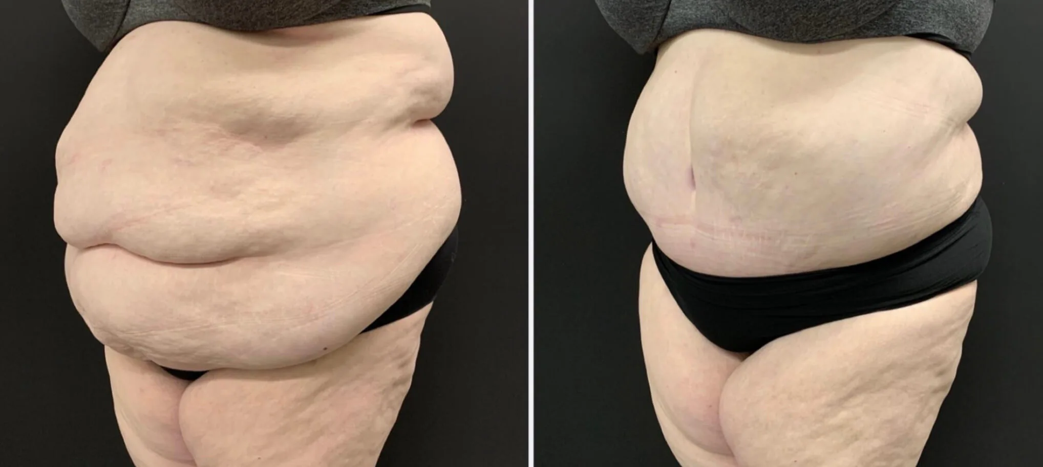 Abdominoplasty Before & After Case Number 00049