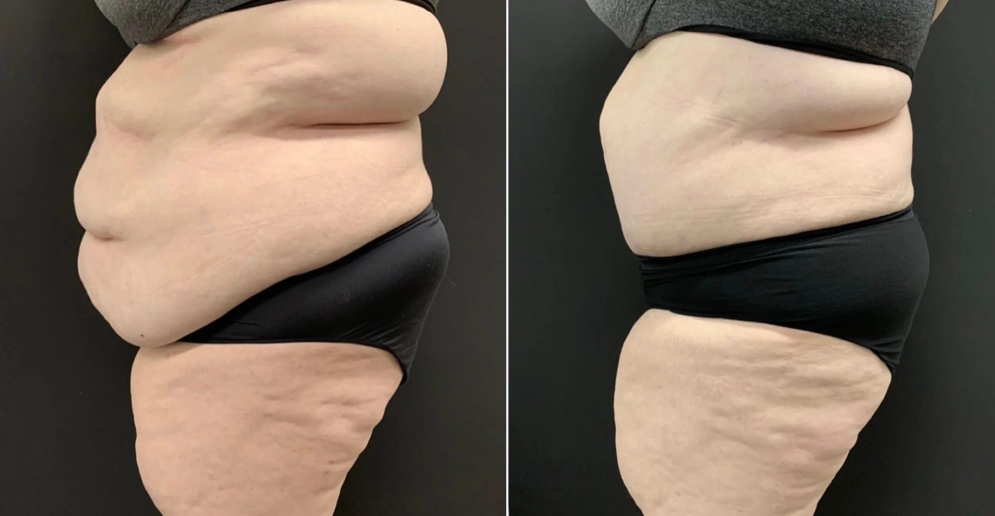Abdominoplasty Before & After Case Number 00049