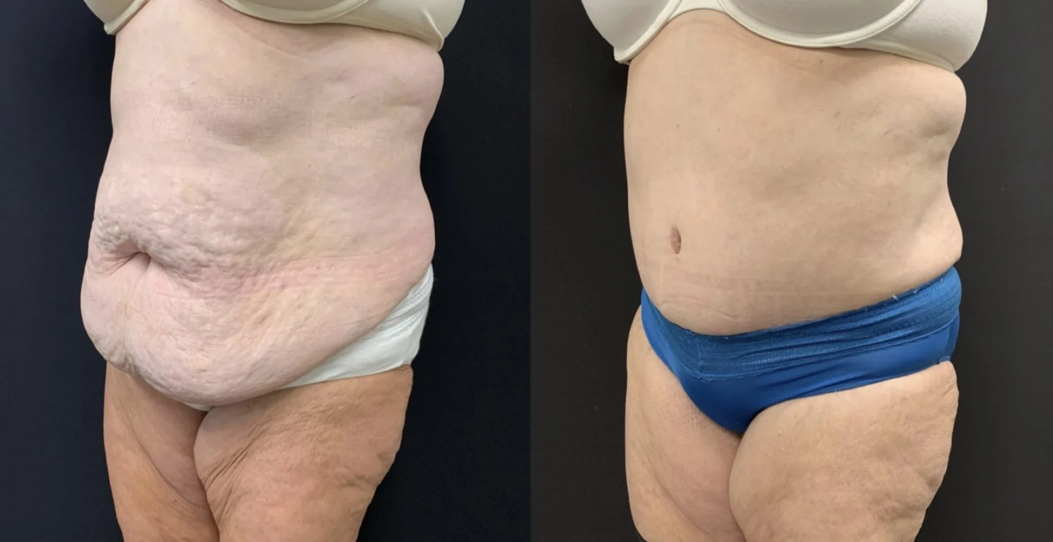 ABDOMINOPLASTY Before & After Case Number 00051