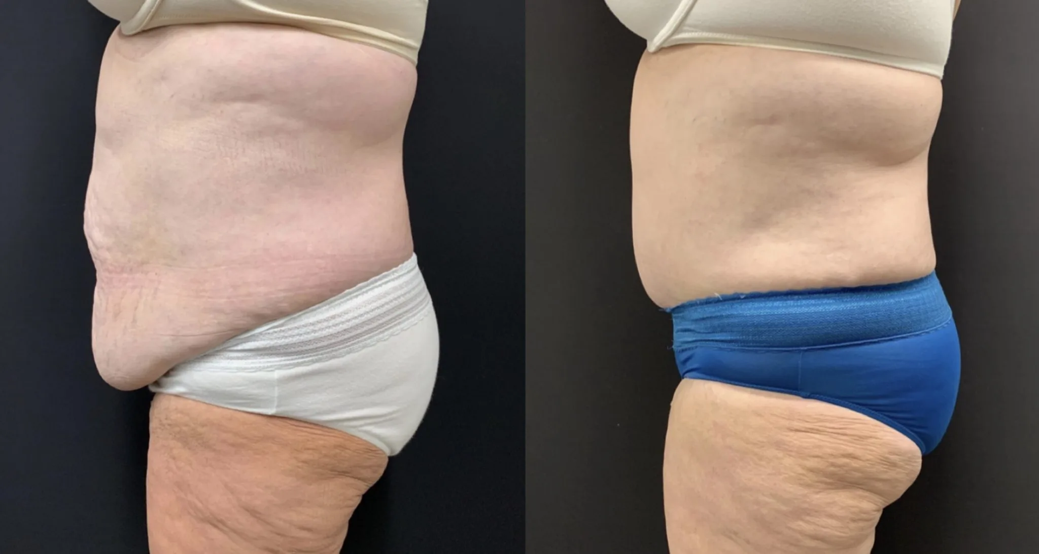 ABDOMINOPLASTY Before & After Case Number 00051