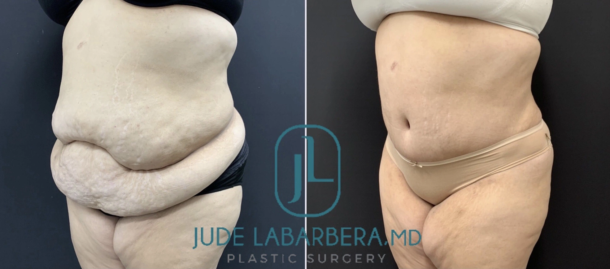 ABDOMINOPLASTY Before & After Case Number 00063