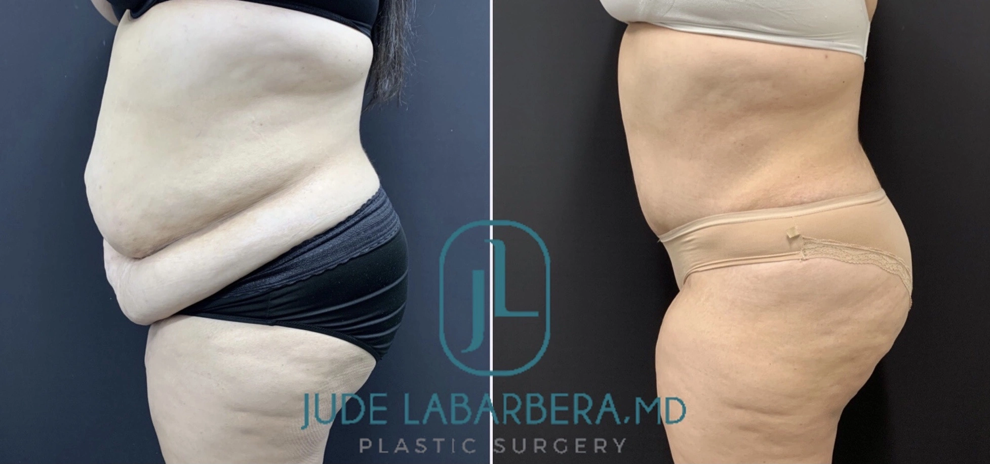 ABDOMINOPLASTY Before & After Case Number 00063