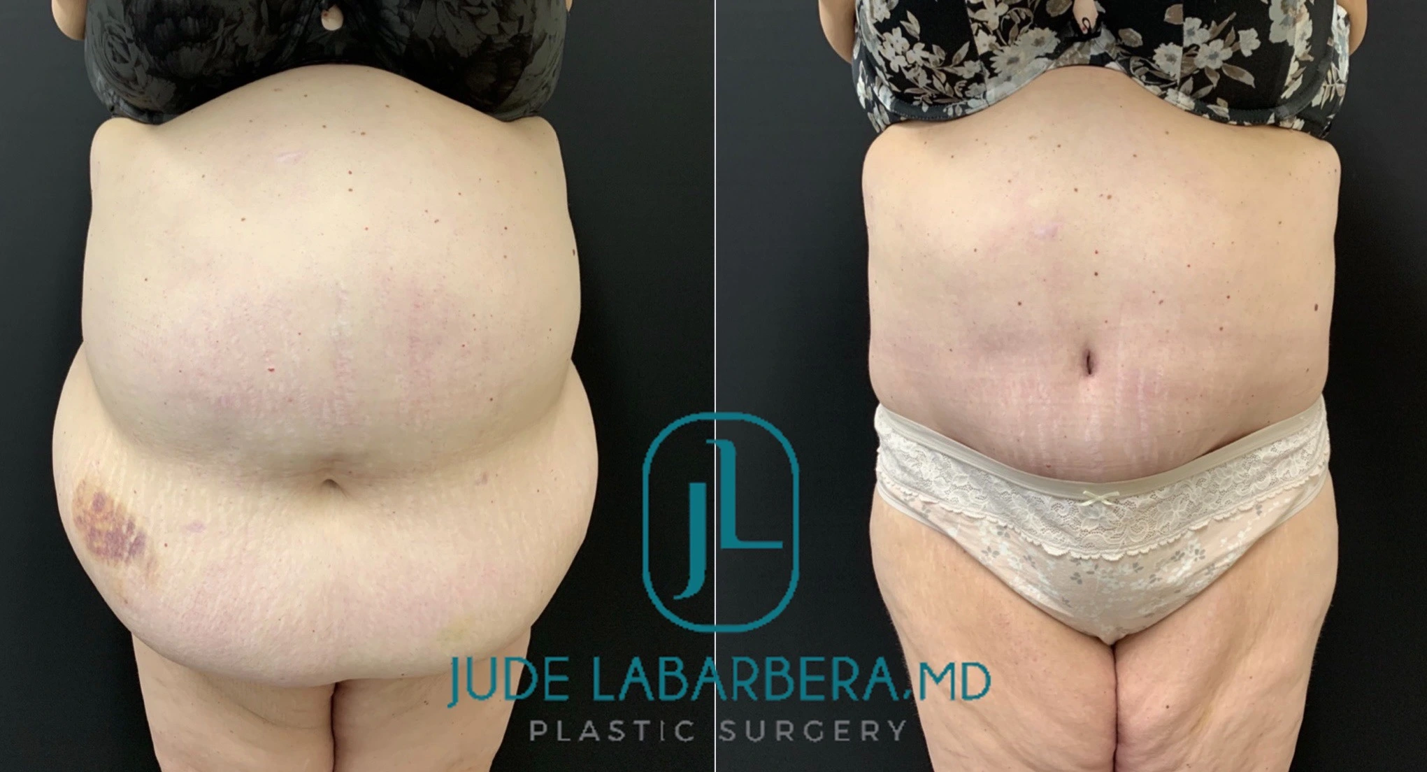 Abdominoplasty Before & After Case Number 00068