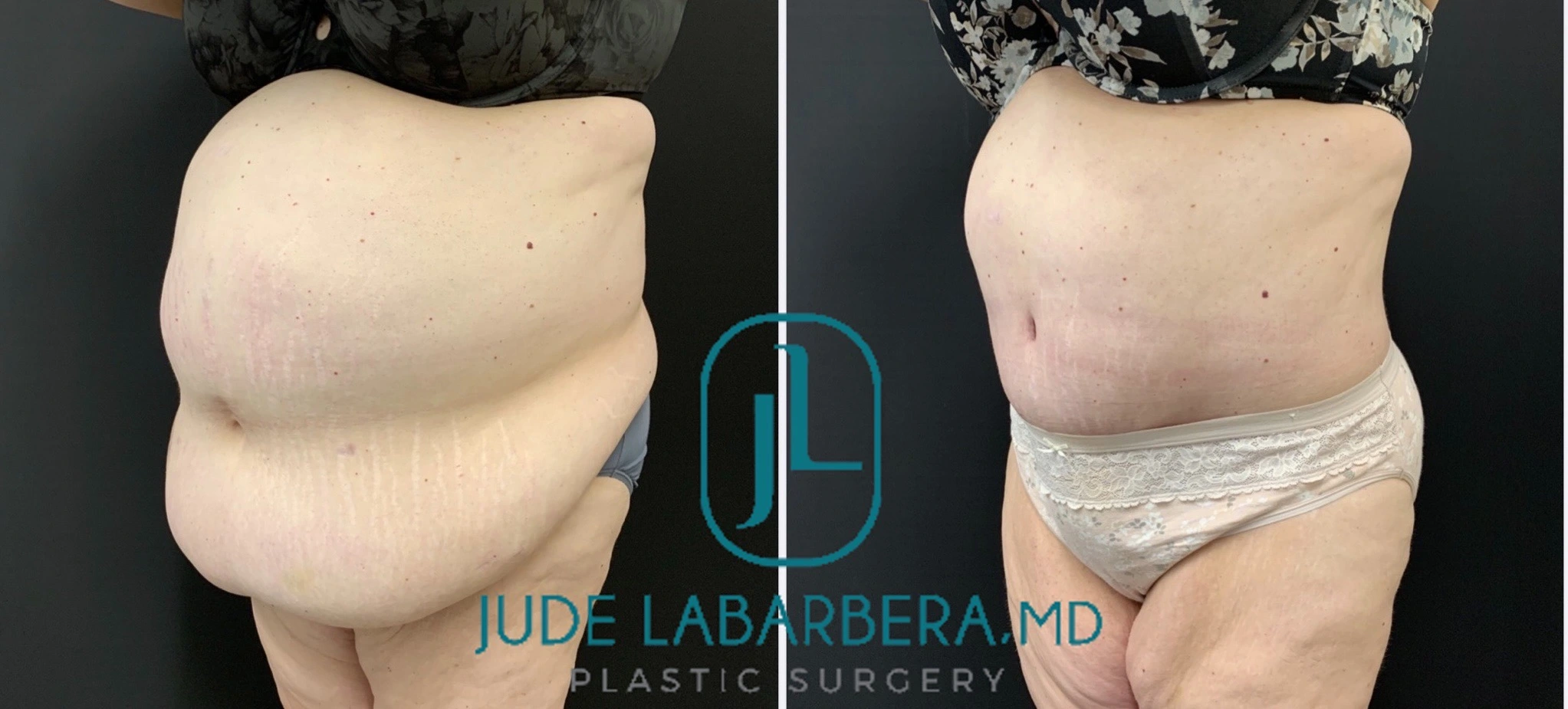 Abdominoplasty Before & After Case Number 00068