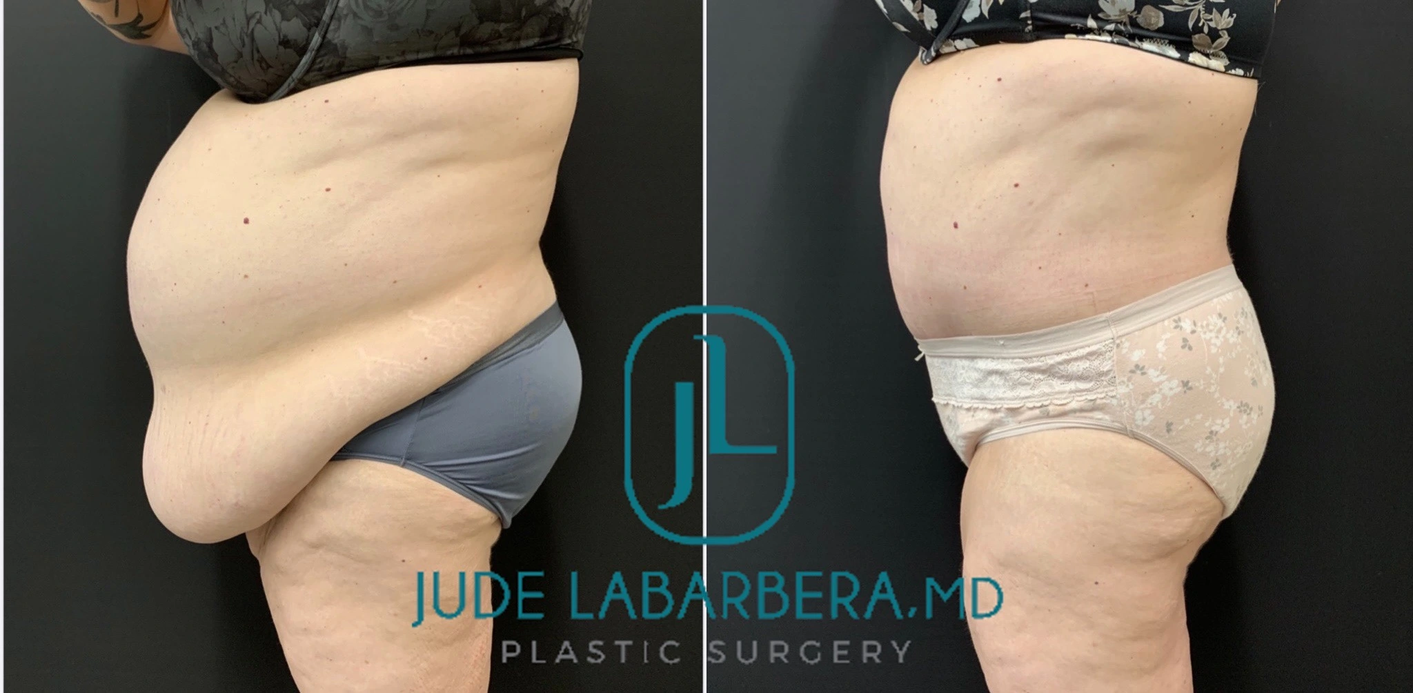 Abdominoplasty Before & After Case Number 00068