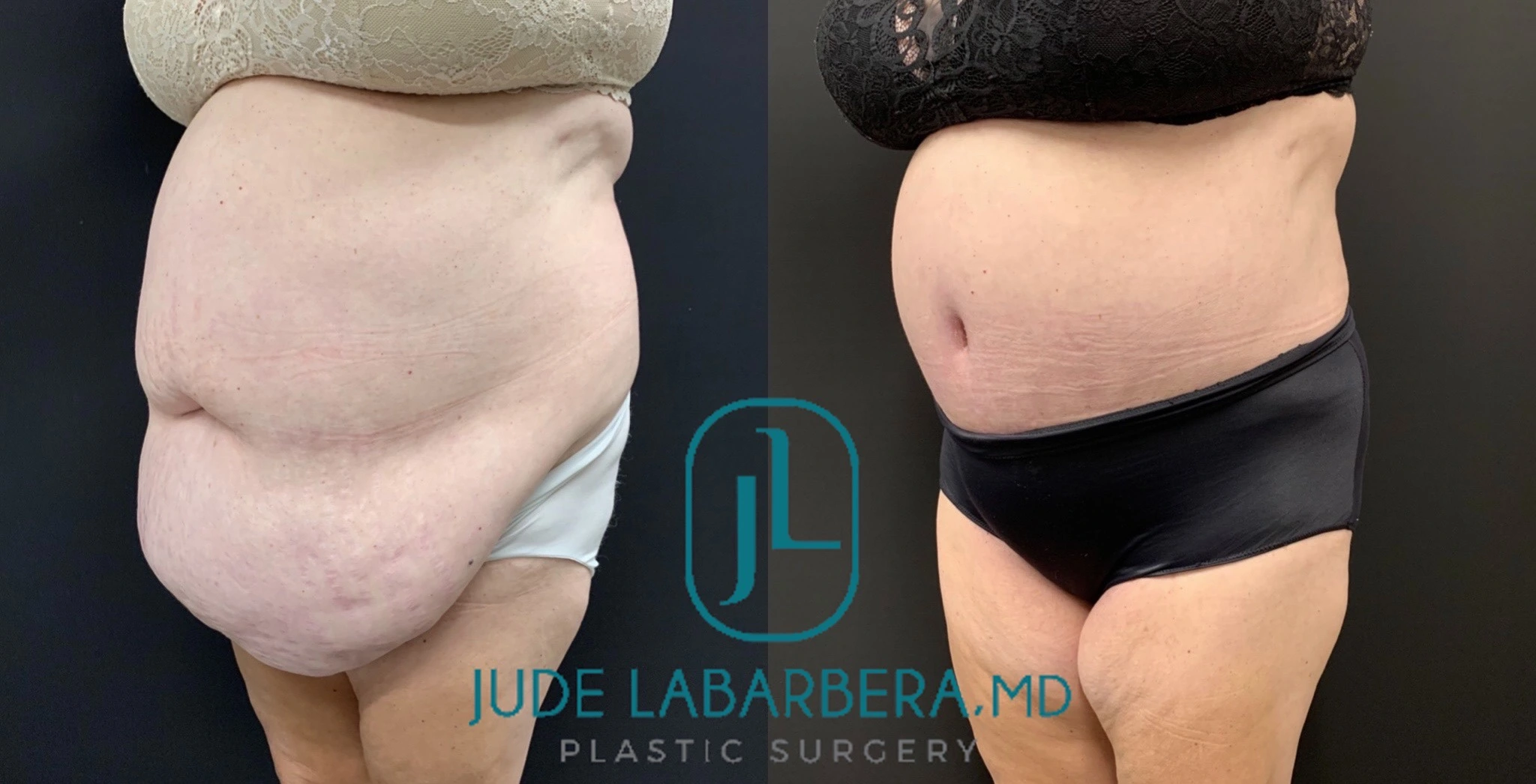 Abdominoplasty Before & After Case Number 00080
