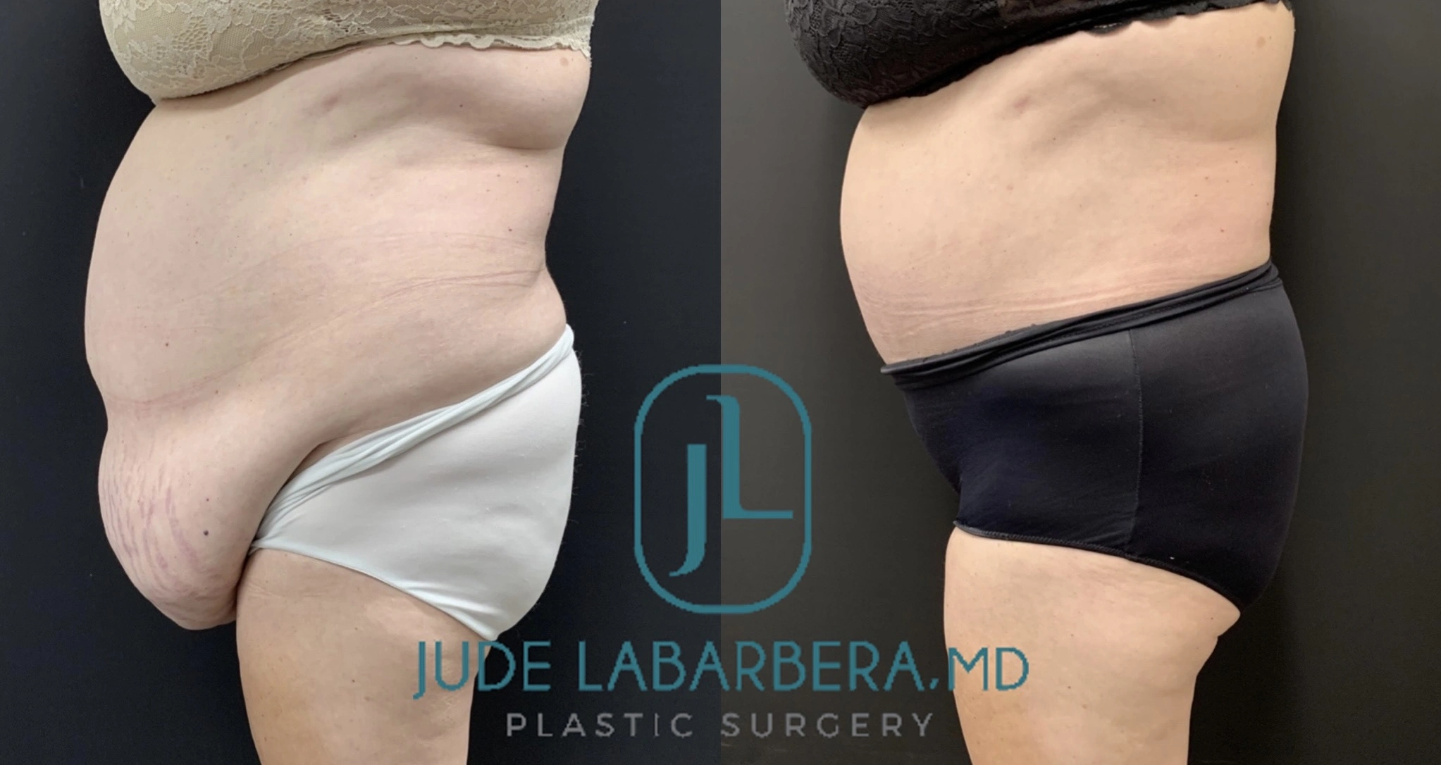 Abdominoplasty Before & After Case Number 00080