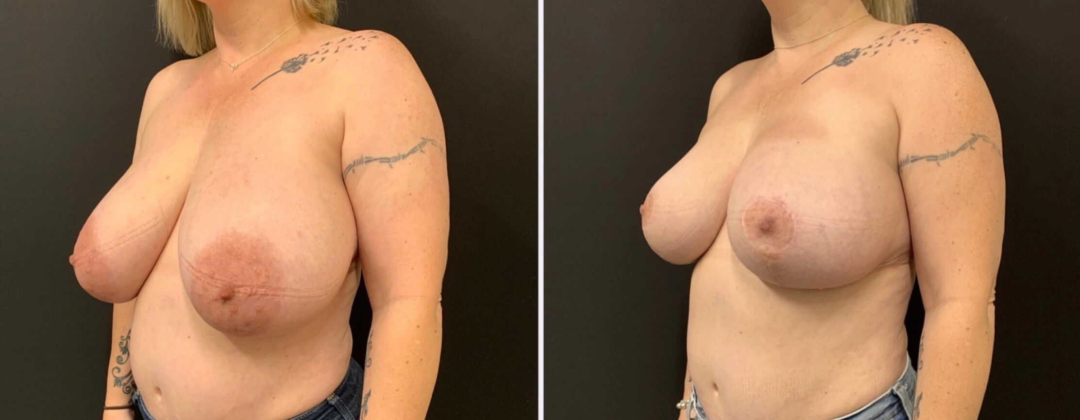 BEAUTIFUL BREAST REDUCTION Before & After Case Number 0001