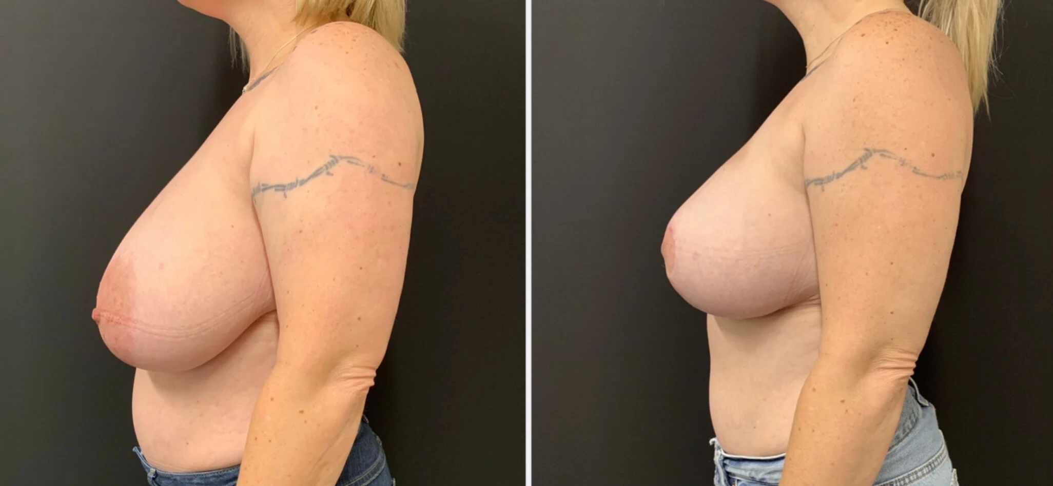 BEAUTIFUL BREAST REDUCTION Before & After Case Number 0001
