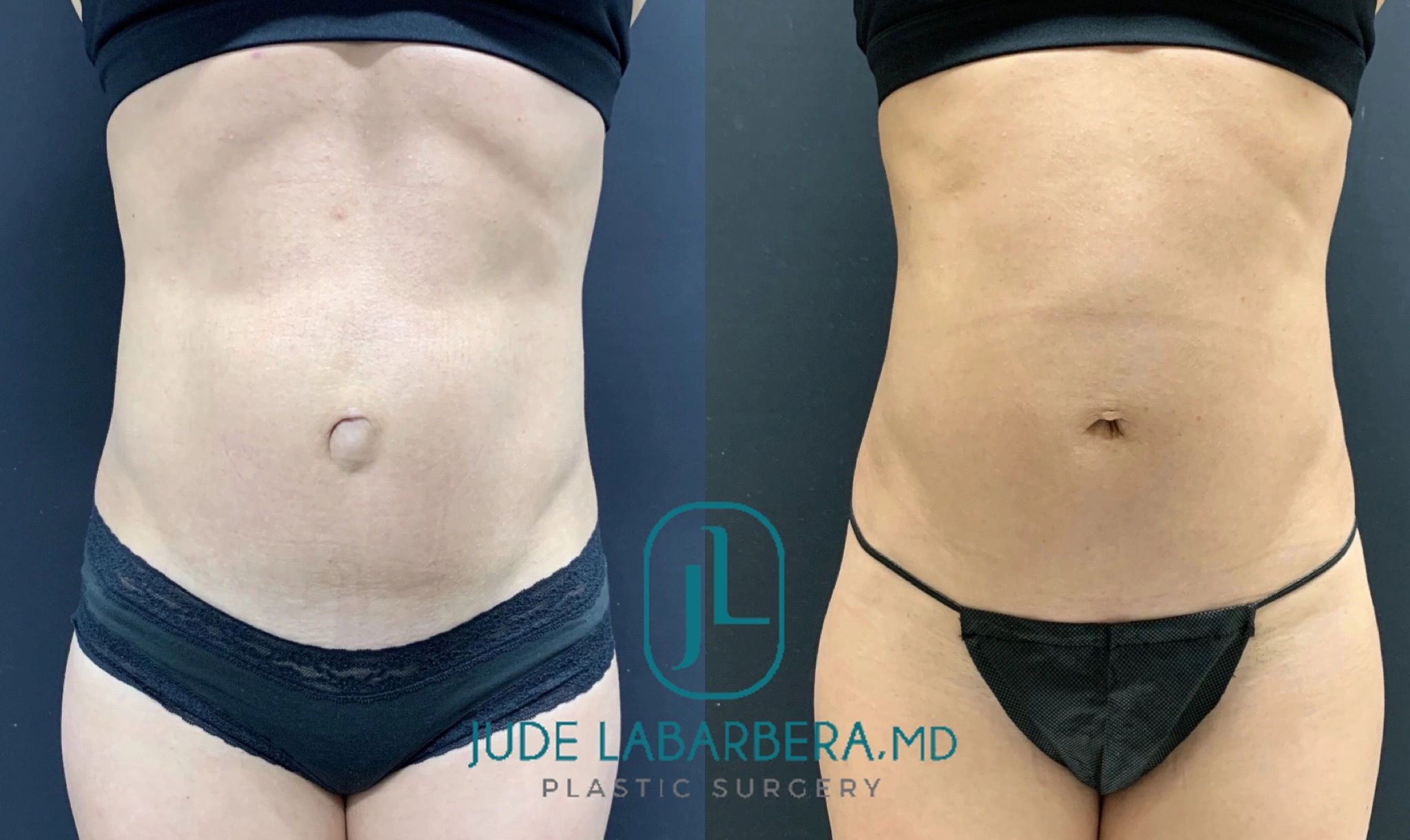 BEAUTIFUL MINI TUMMY TUCK WITH UMBILICAL HERNIA Before & After Case Number 000115
