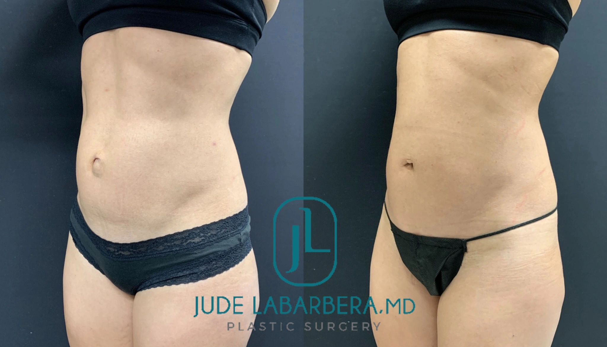 BEAUTIFUL MINI TUMMY TUCK WITH UMBILICAL HERNIA Before & After Case Number 000115