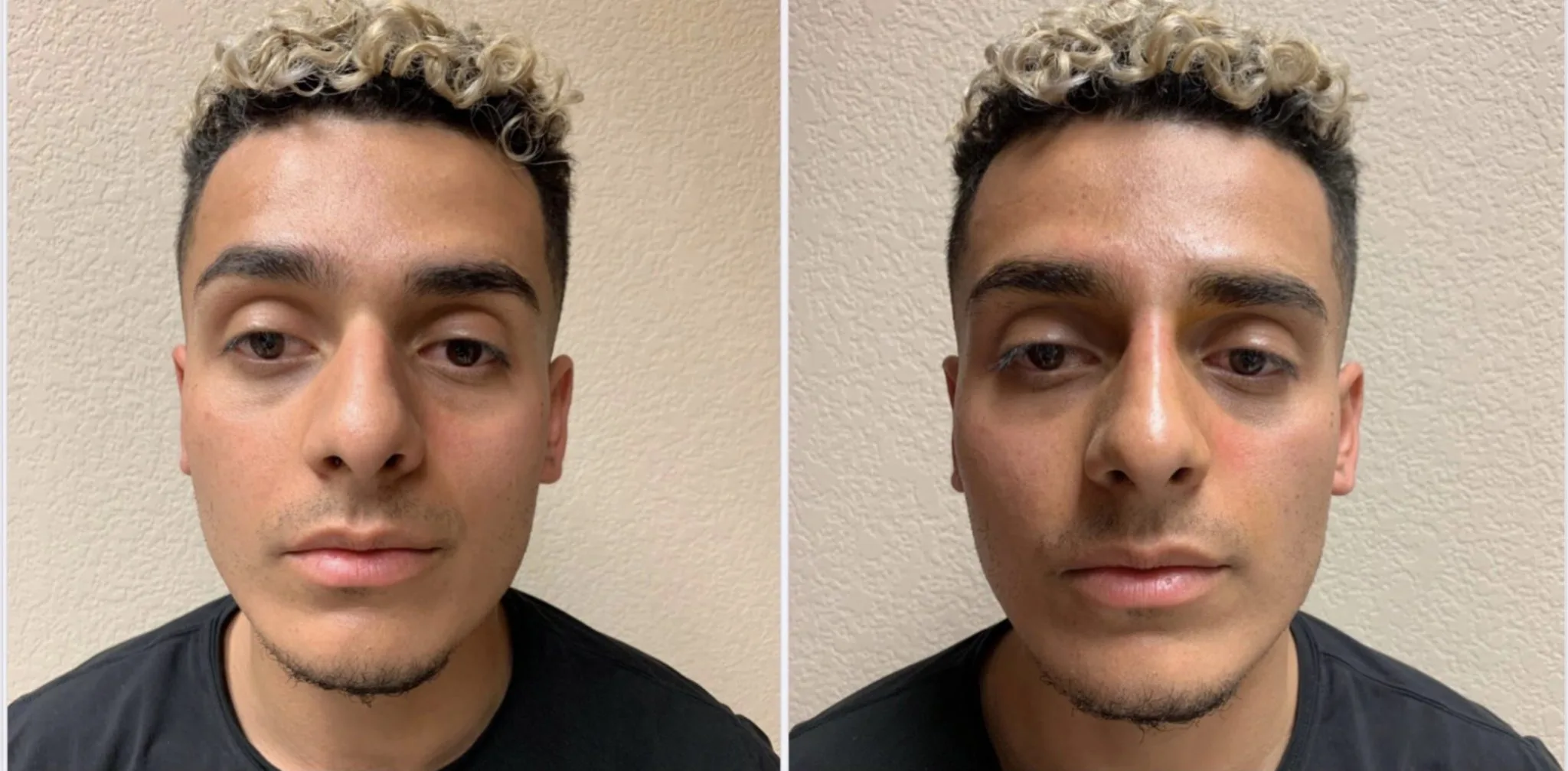 BEAUTIFUL NON-SURGICAL RHINOPLASTY Before & After Case Number 0004