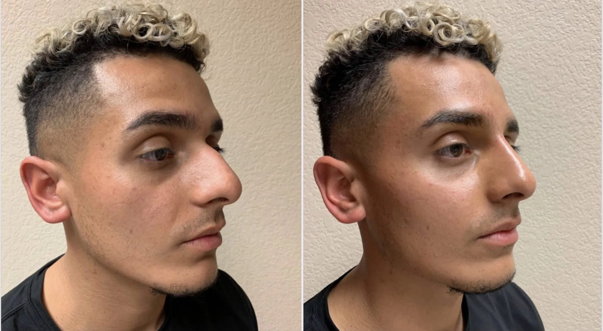 BEAUTIFUL NON-SURGICAL RHINOPLASTY Before & After Case Number 0004