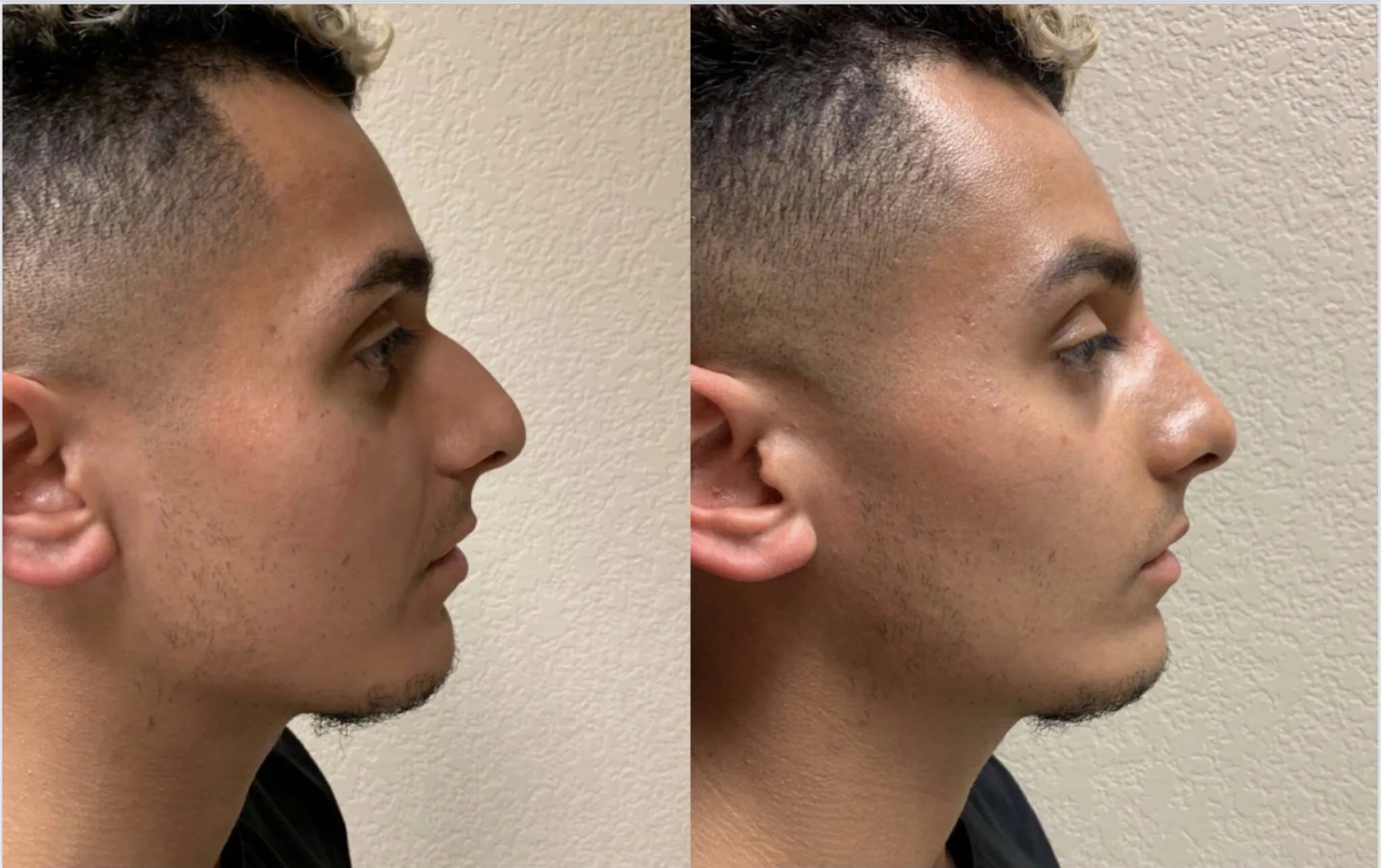 BEAUTIFUL NON-SURGICAL RHINOPLASTY Before & After Case Number 0004