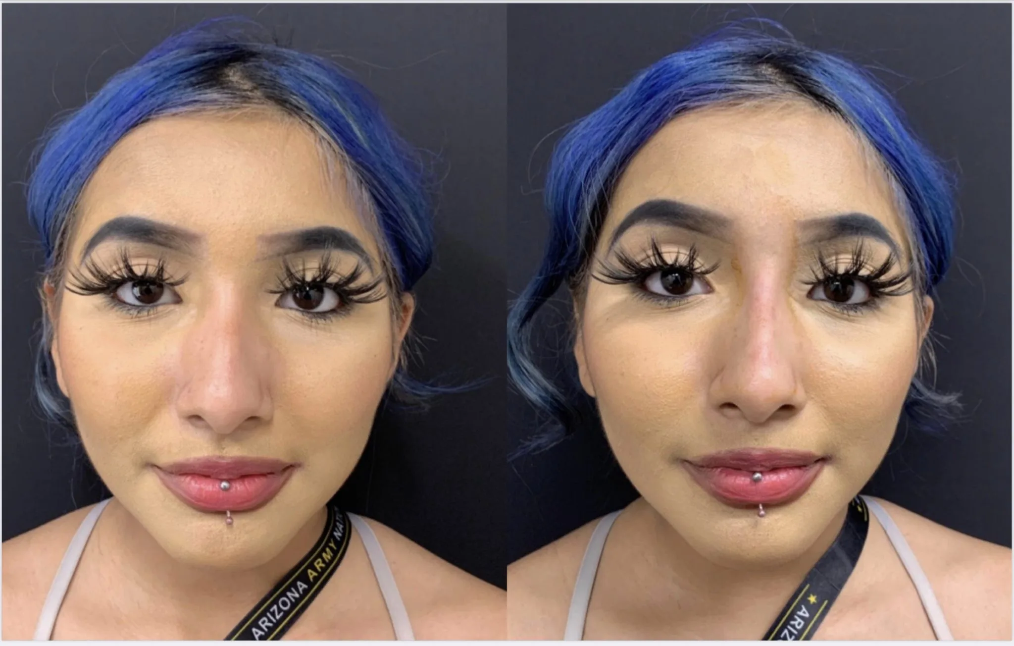 BEAUTIFUL NON-SURGICAL RHINOPLASTY Before & After Case Number 0005