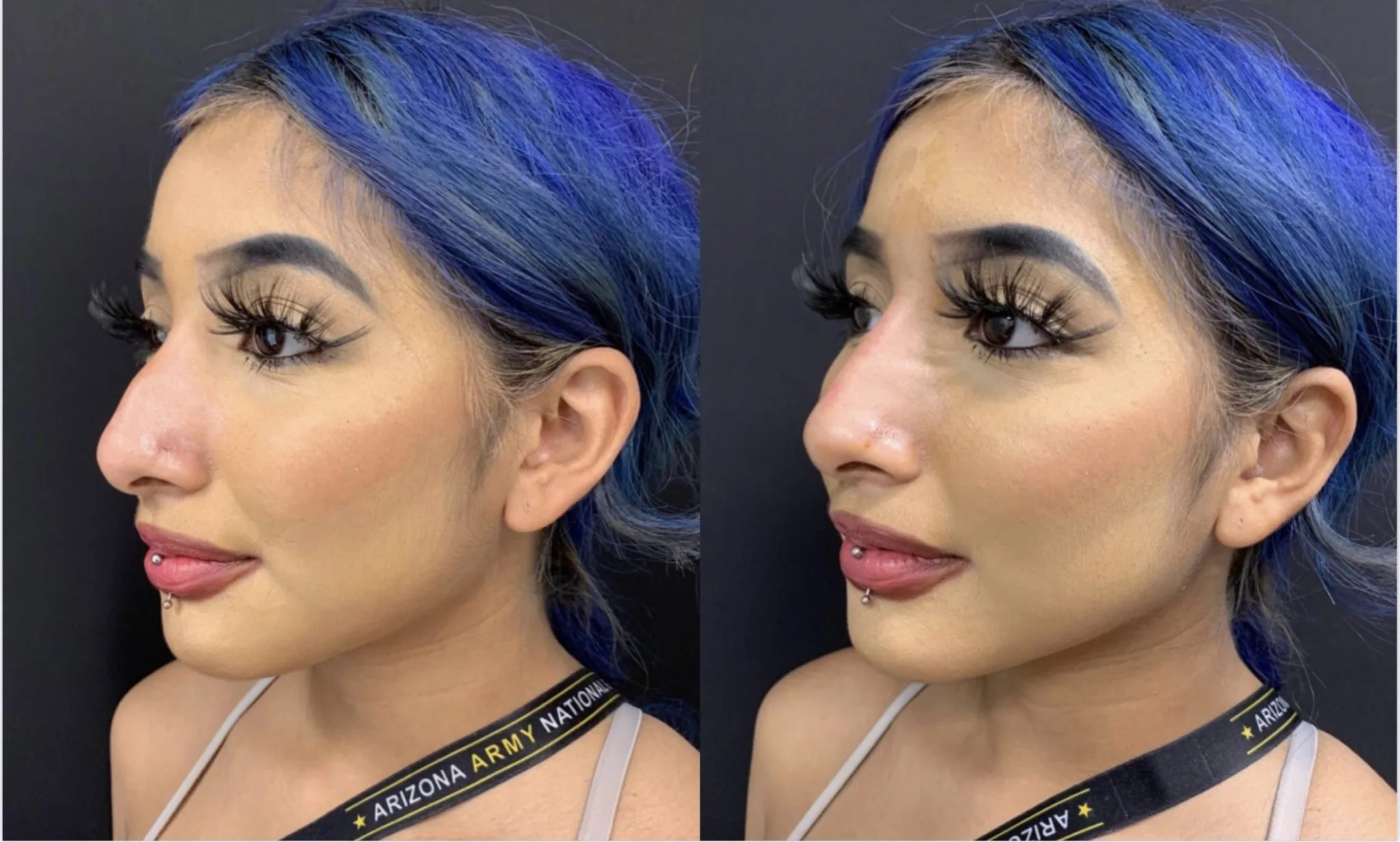 BEAUTIFUL NON-SURGICAL RHINOPLASTY Before & After Case Number 0005