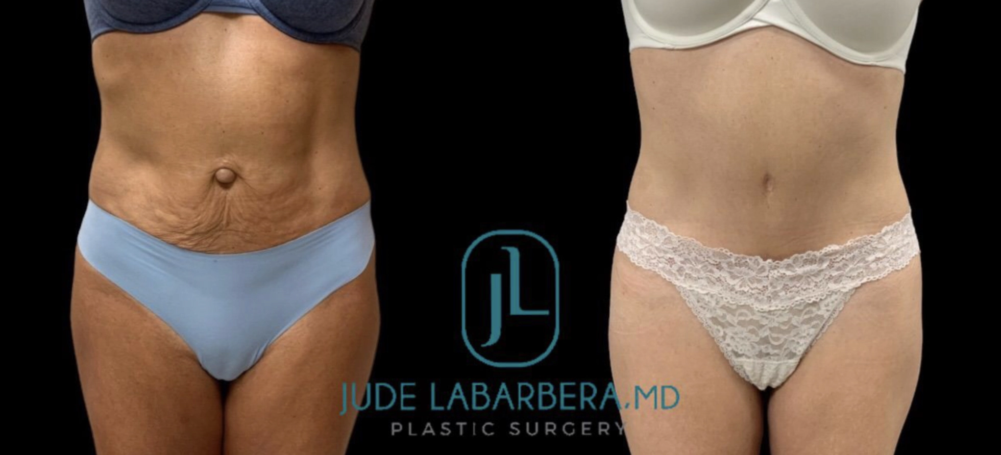 BEAUTIFUL TUMMY TUCK WITH UMBILICAL HERNIA REPAIR Before & After Case Number 000101