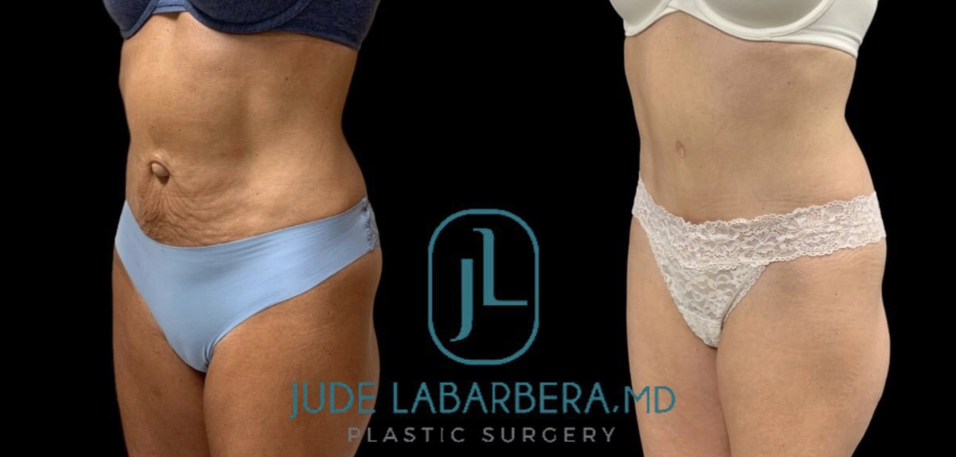 BEAUTIFUL TUMMY TUCK WITH UMBILICAL HERNIA REPAIR Before & After Case Number 000101