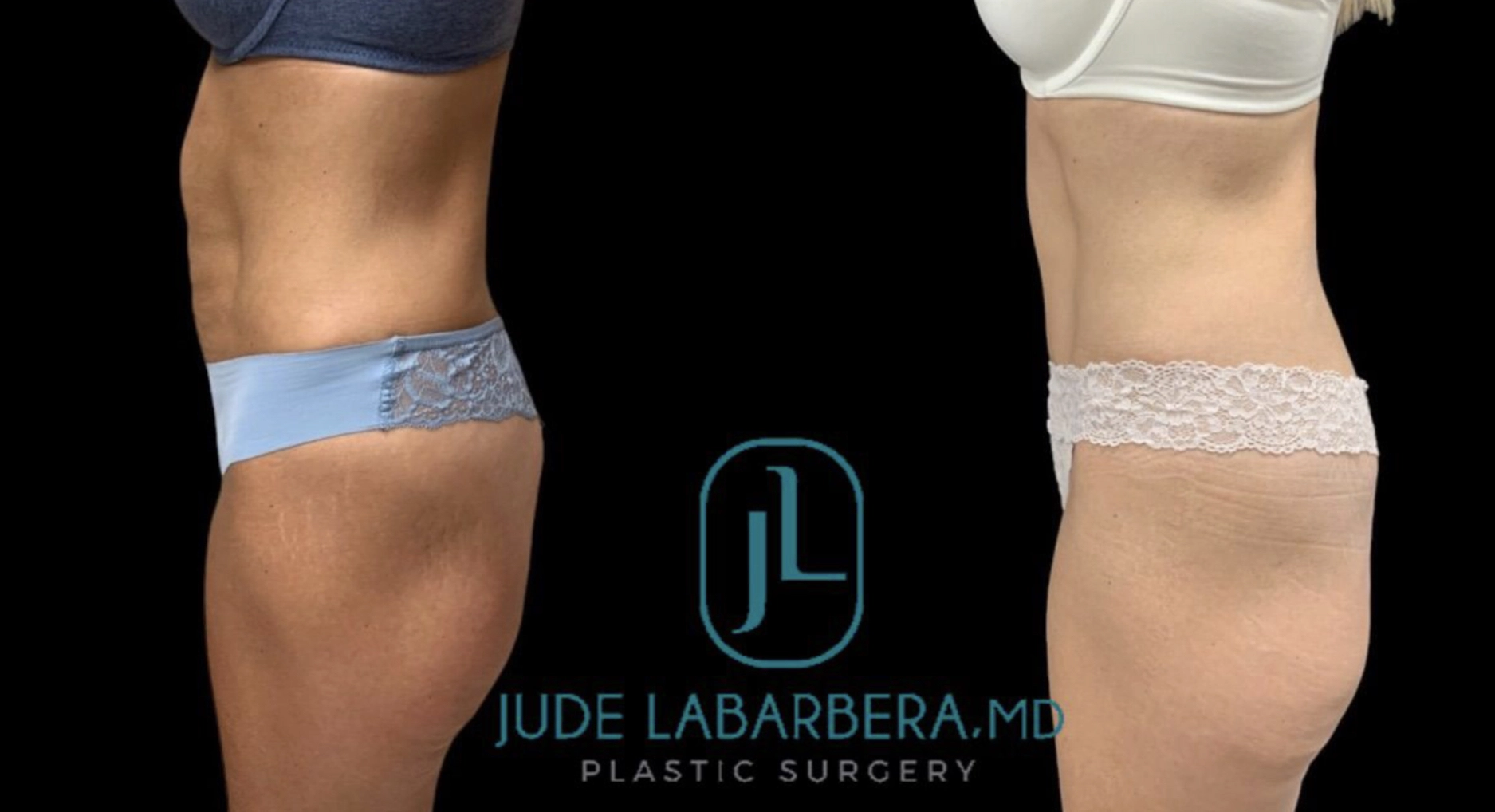 BEAUTIFUL TUMMY TUCK WITH UMBILICAL HERNIA REPAIR Before & After Case Number 000101