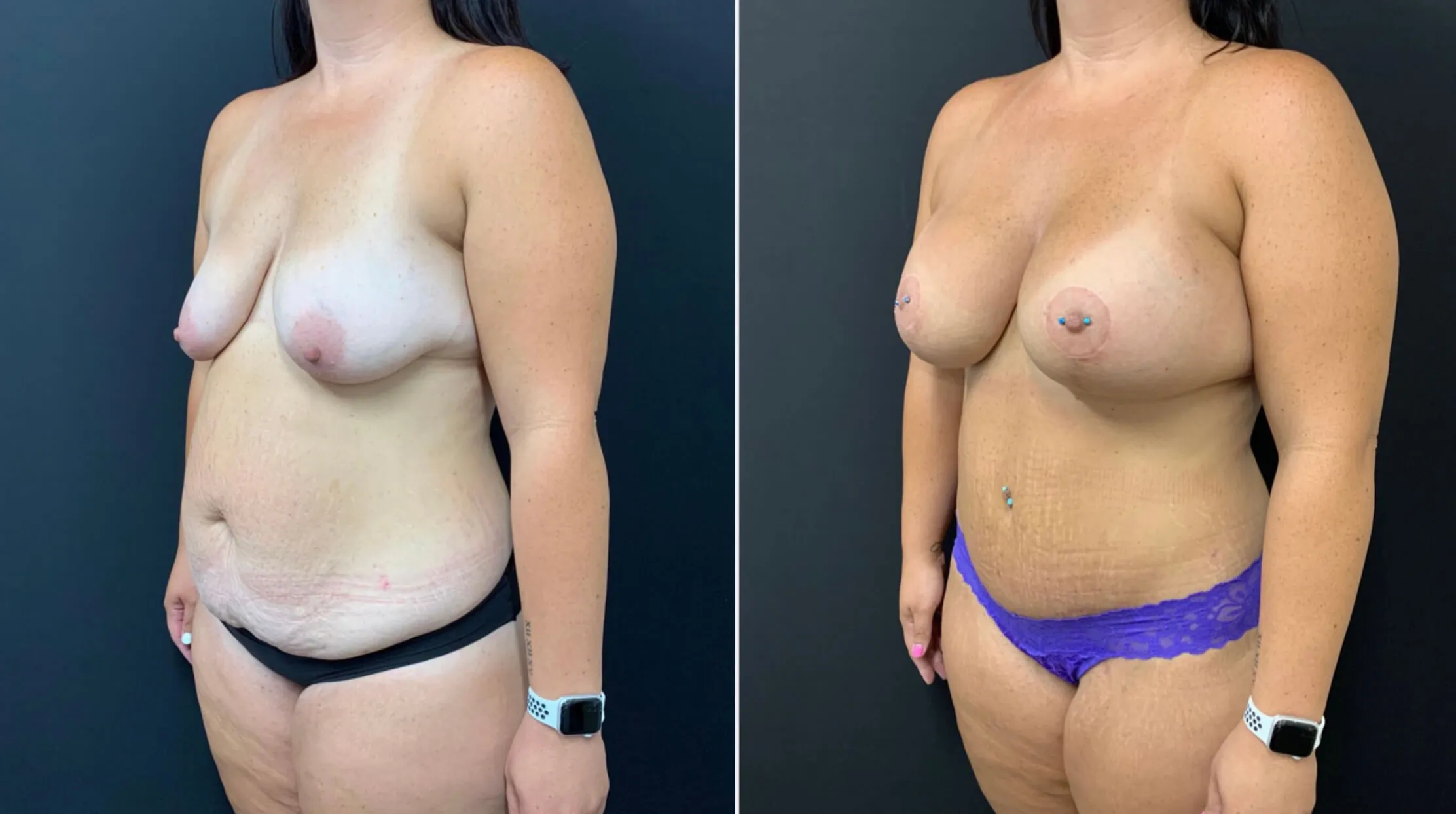 BEAUTIFUL ULTRA HIGH PROFILE BREAST AUGMENTATION WITH LIFT AND TUMMY TUCK Before & After Case Number 0001