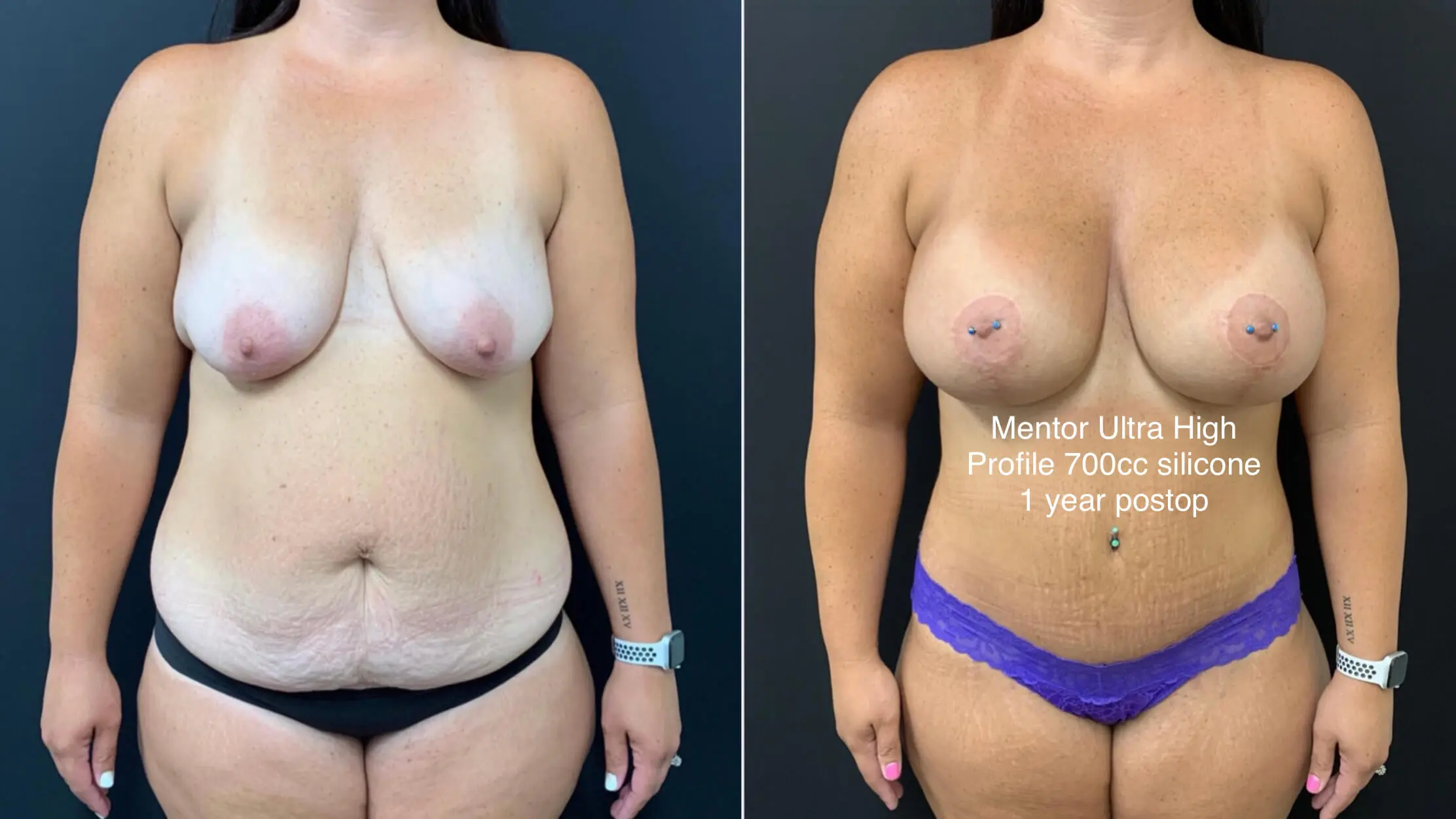 BEAUTIFUL ULTRA HIGH PROFILE BREAST AUGMENTATION WITH LIFT AND TUMMY TUCK Before & After Case Number 0001