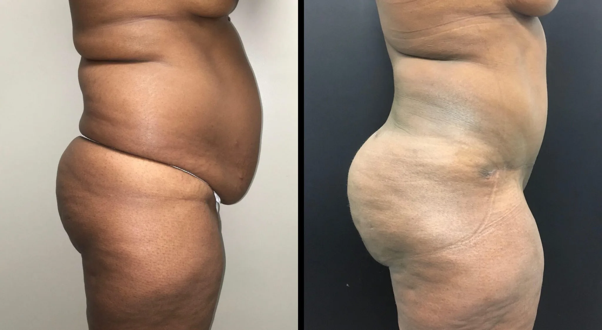 BRAZILIAN BUTT LIFT Before & After Case Number 0002