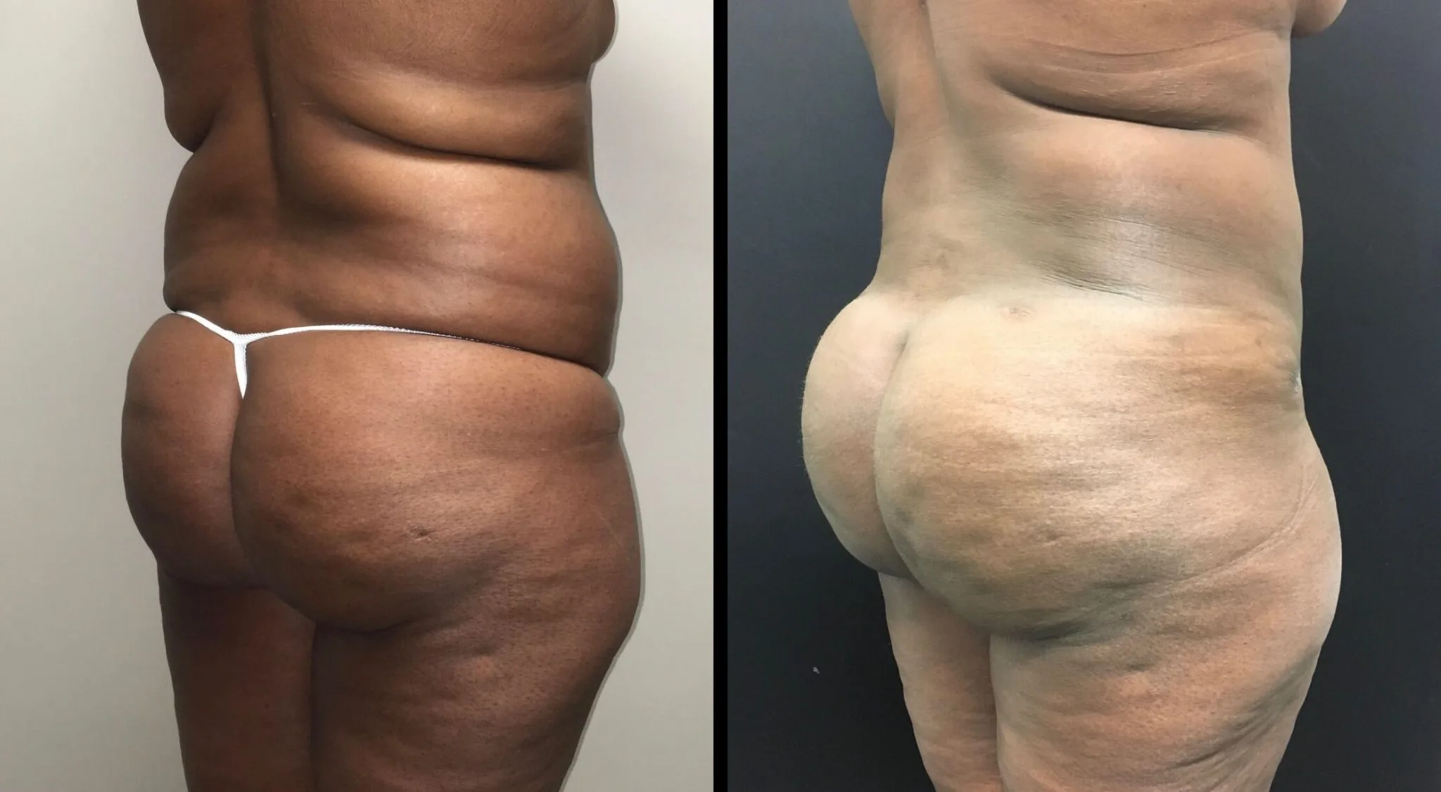 BRAZILIAN BUTT LIFT Before & After Case Number 0002