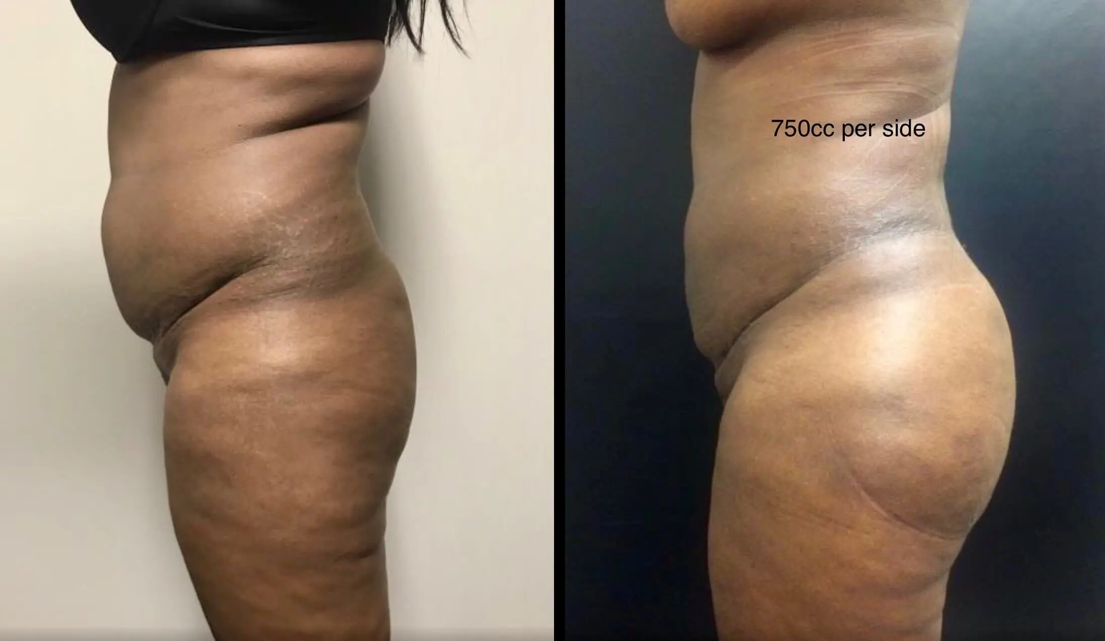 BRAZILIAN BUTT LIFT Before & After Case Number 0003