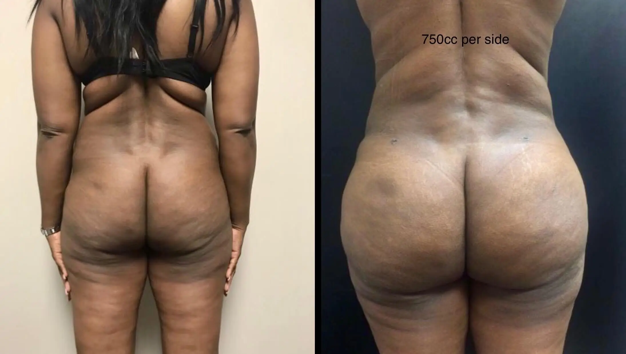 BRAZILIAN BUTT LIFT Before & After Case Number 0003