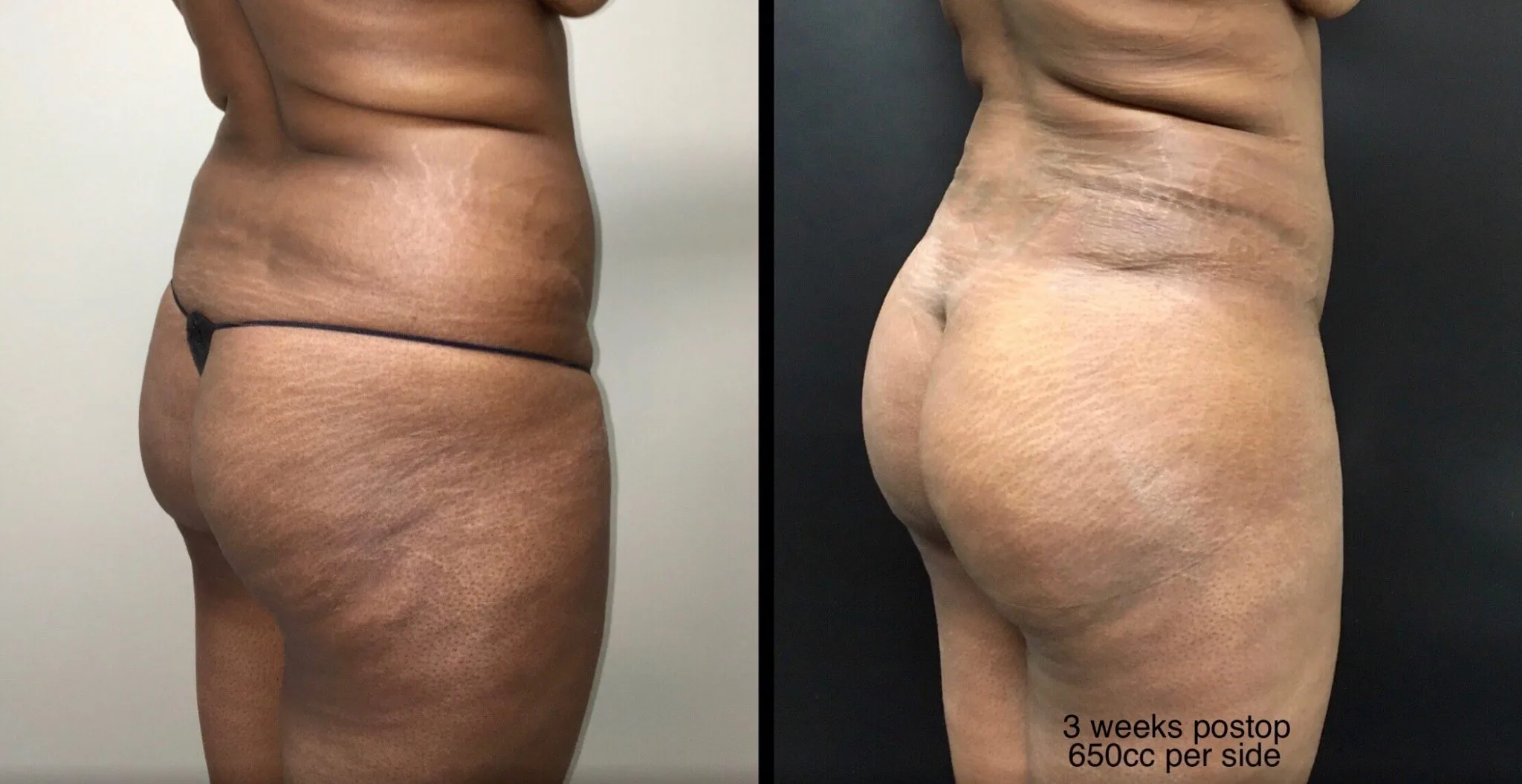 BRAZILIAN BUTT LIFT Before & After Case Number 0004