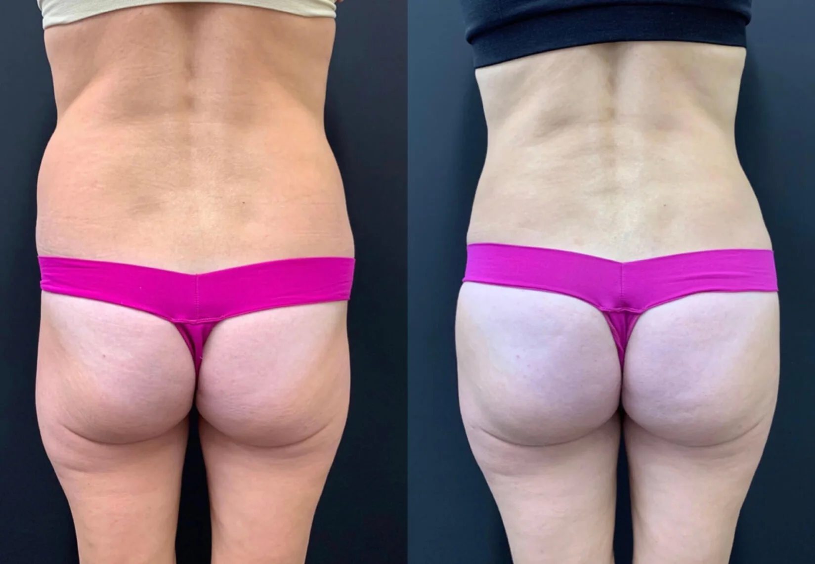 BRAZILIAN BUTT LIFT Before & After Case Number 0005