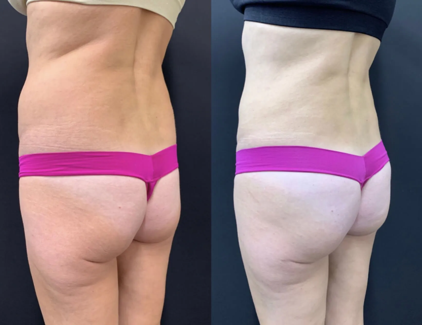 BRAZILIAN BUTT LIFT Before & After Case Number 0005