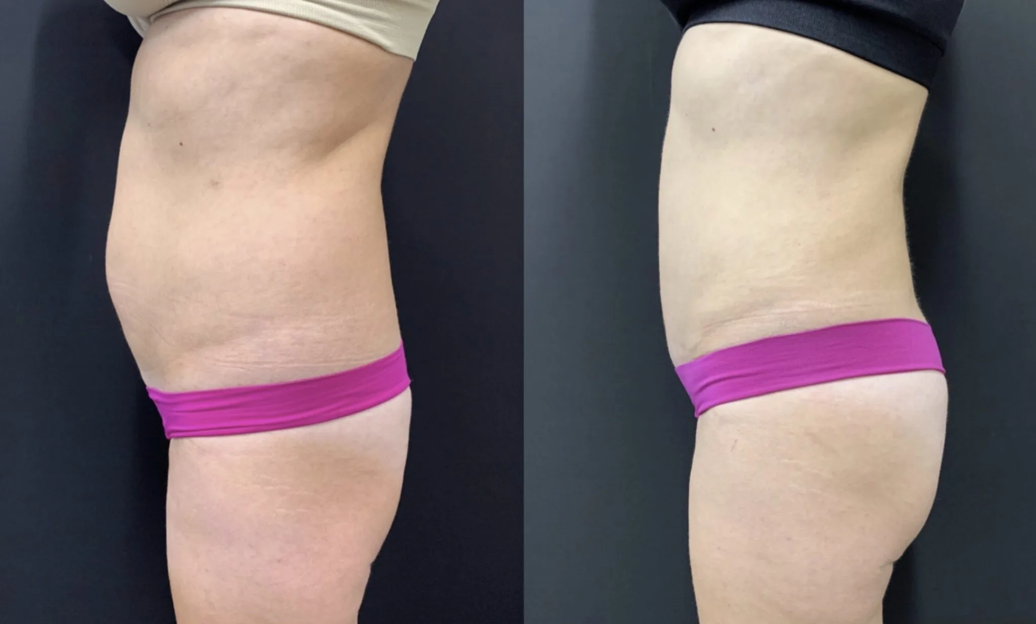 BRAZILIAN BUTT LIFT Before & After Case Number 0005