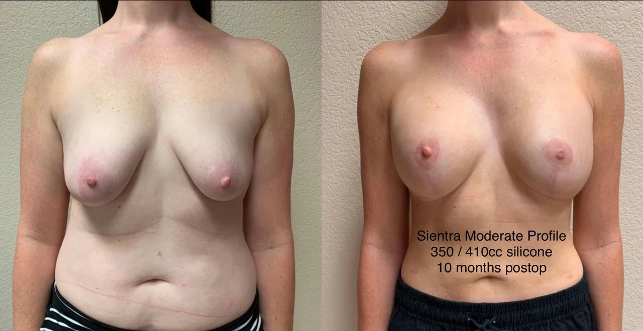 BREAST ASYMMETRY CORRECTION Before & After Case Number 0001