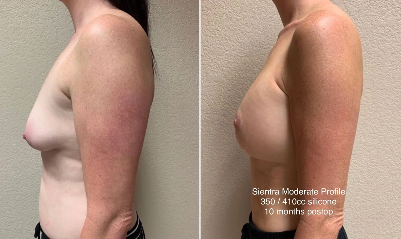 BREAST ASYMMETRY CORRECTION Before & After Case Number 0001
