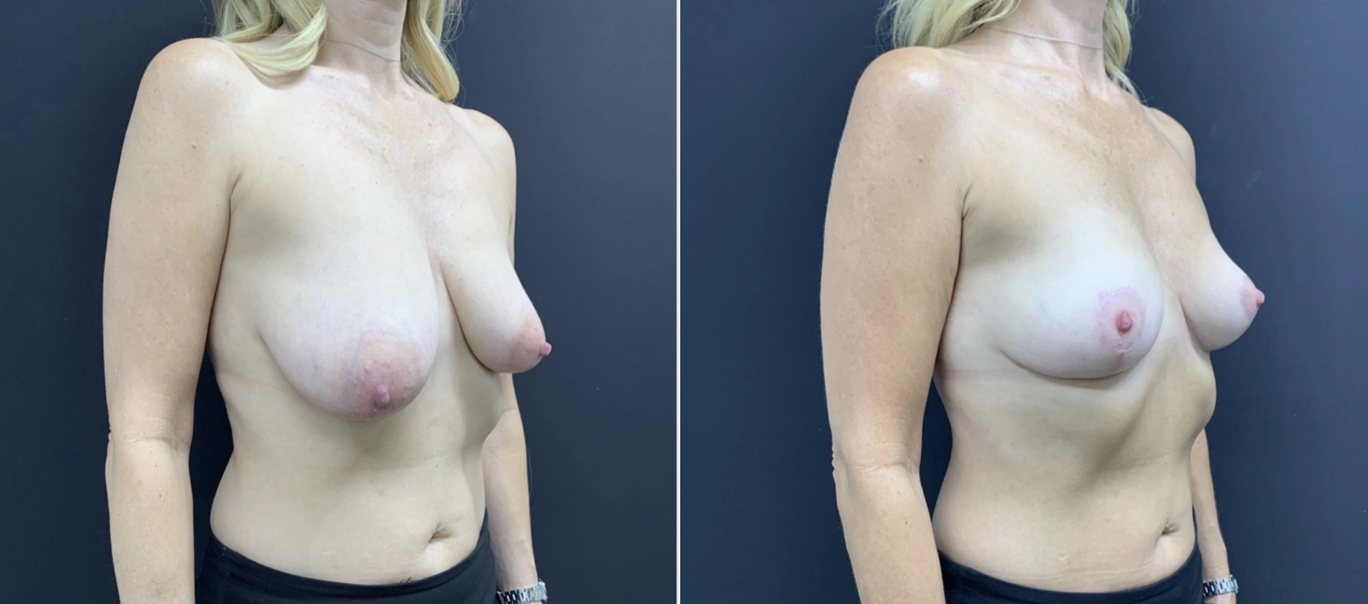 BREAST ASYMMETRY CORRECTION Before & After Case Number 0007