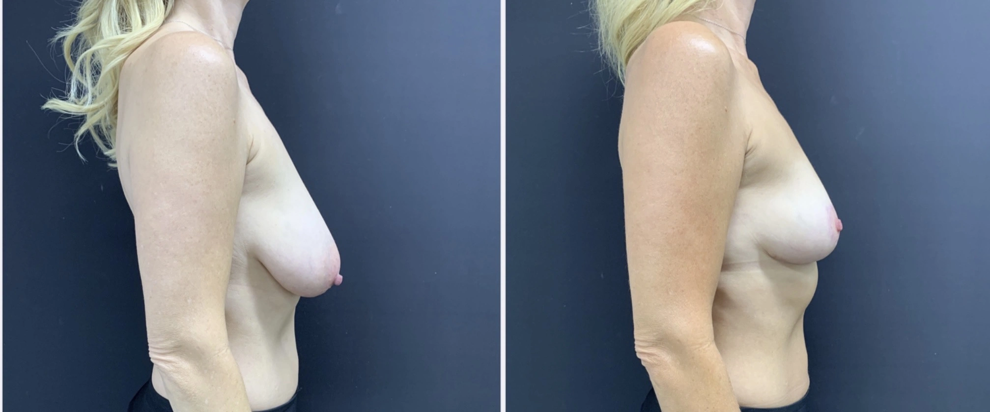 BREAST ASYMMETRY CORRECTION Before & After Case Number 0007